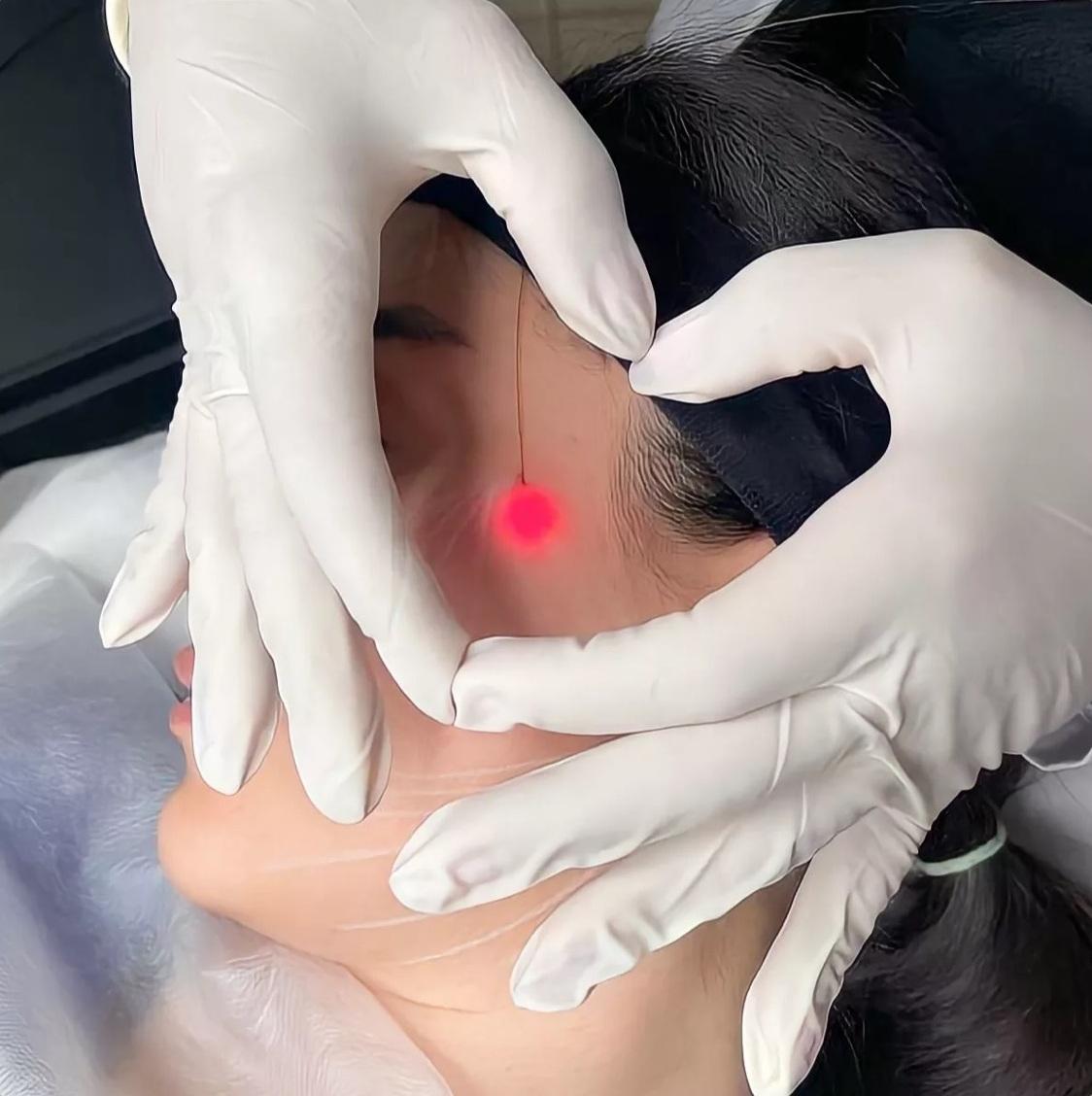 ENDOLIFT LASER