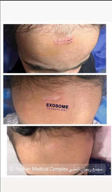 Αποτέλεσμα θεραπείας Advanced Derma 1