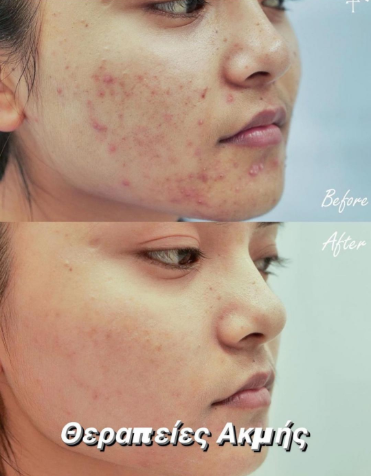 Αποτέλεσμα θεραπείας Advanced Derma 12