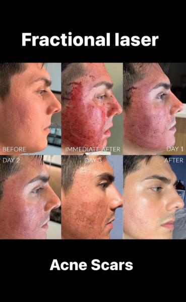 Αποτέλεσμα θεραπείας Advanced Derma 15