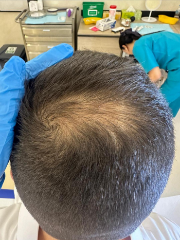 Αποτέλεσμα θεραπείας Advanced Derma 18