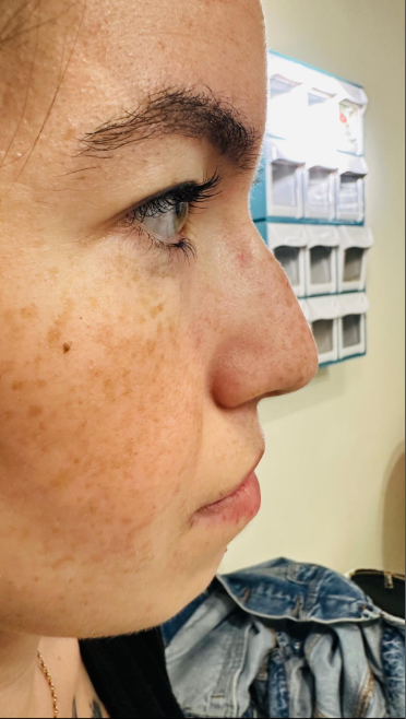 Αποτέλεσμα θεραπείας Advanced Derma 20