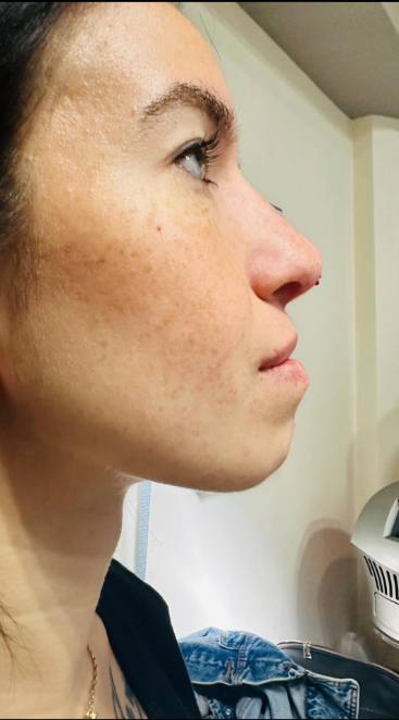 Αποτέλεσμα θεραπείας Advanced Derma 21
