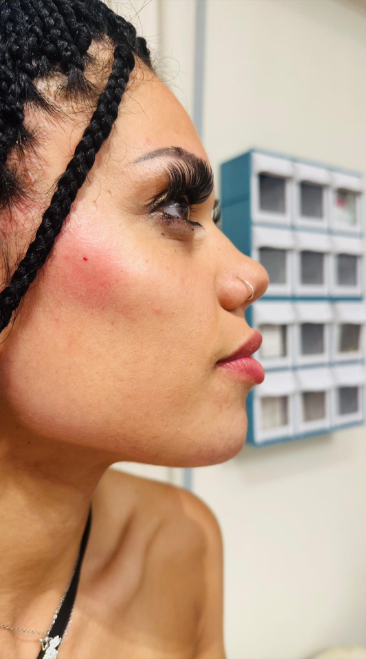 Αποτέλεσμα θεραπείας Advanced Derma 23
