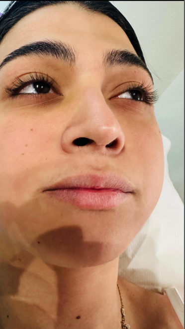 Αποτέλεσμα θεραπείας Advanced Derma 24
