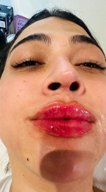 Αποτέλεσμα θεραπείας Advanced Derma 25