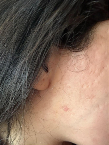 Αποτέλεσμα θεραπείας Advanced Derma 26