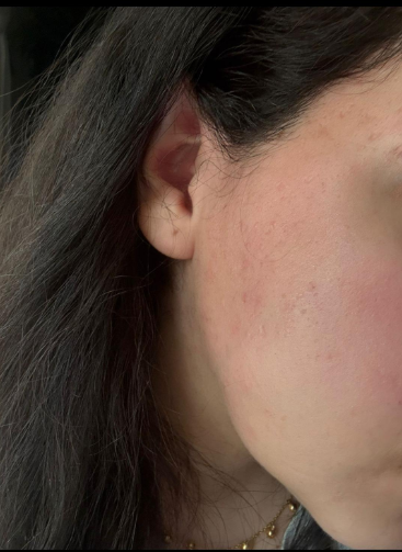 Αποτέλεσμα θεραπείας Advanced Derma 27