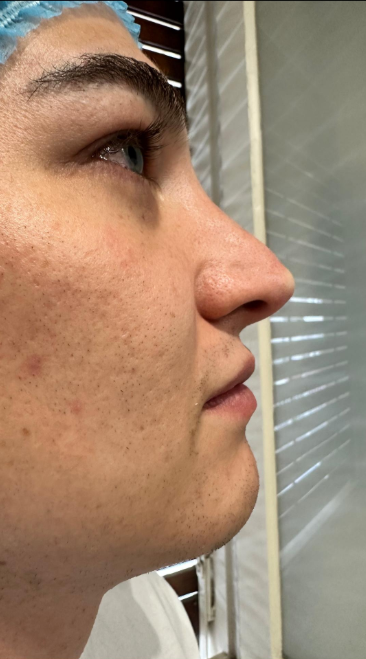 Αποτέλεσμα θεραπείας Advanced Derma 30