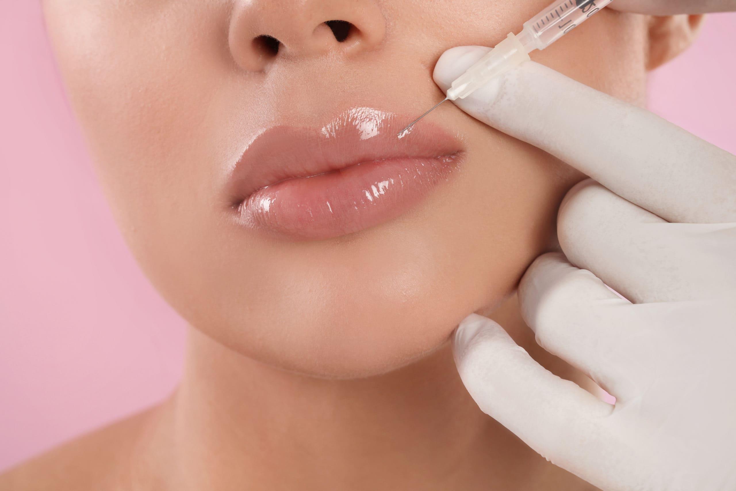 LIP FILLER