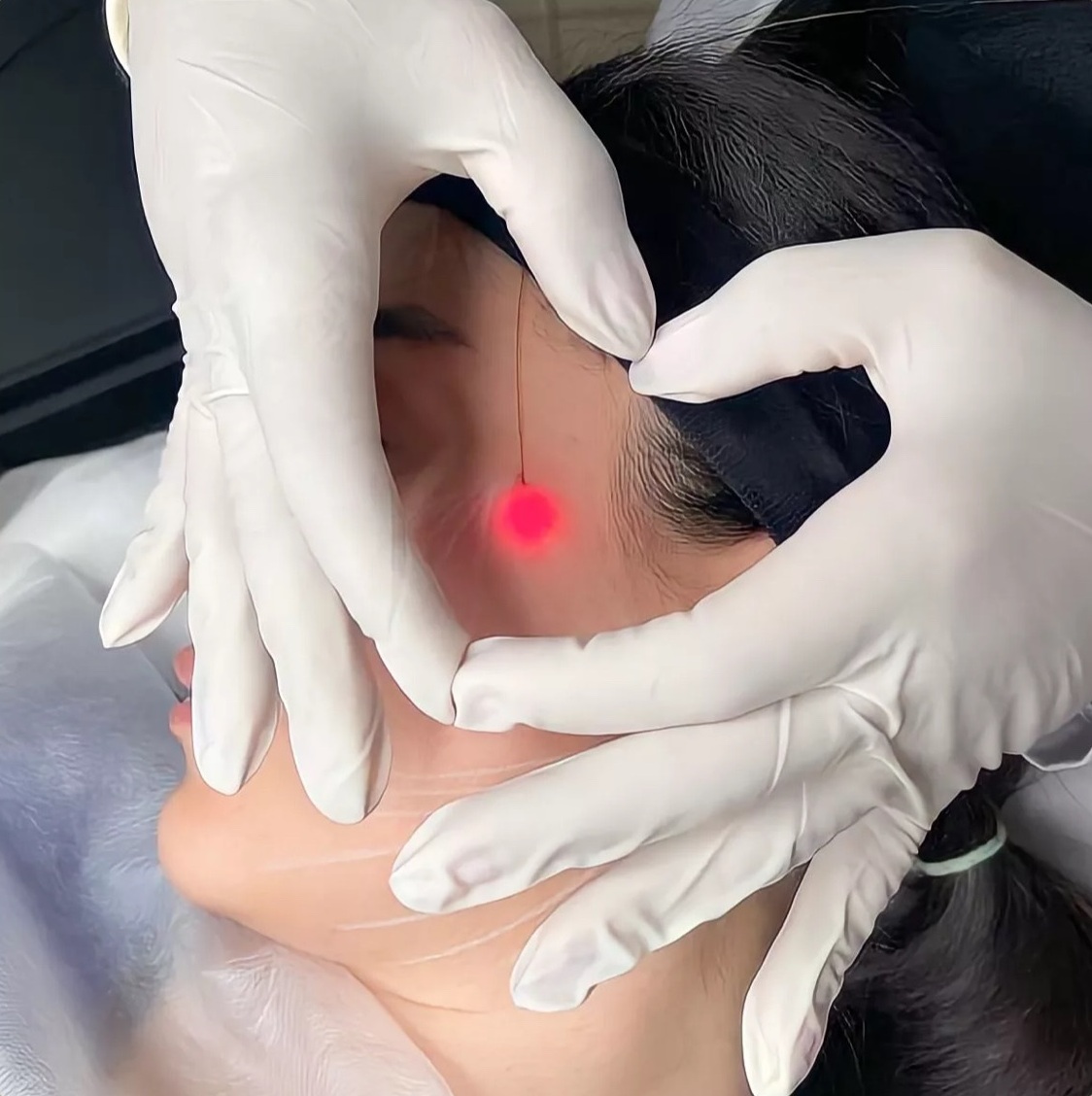ENDOLIFT LASER