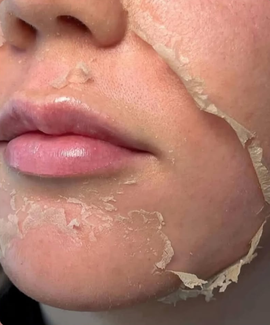 Χημικό Peeling — αποτέλεσμα