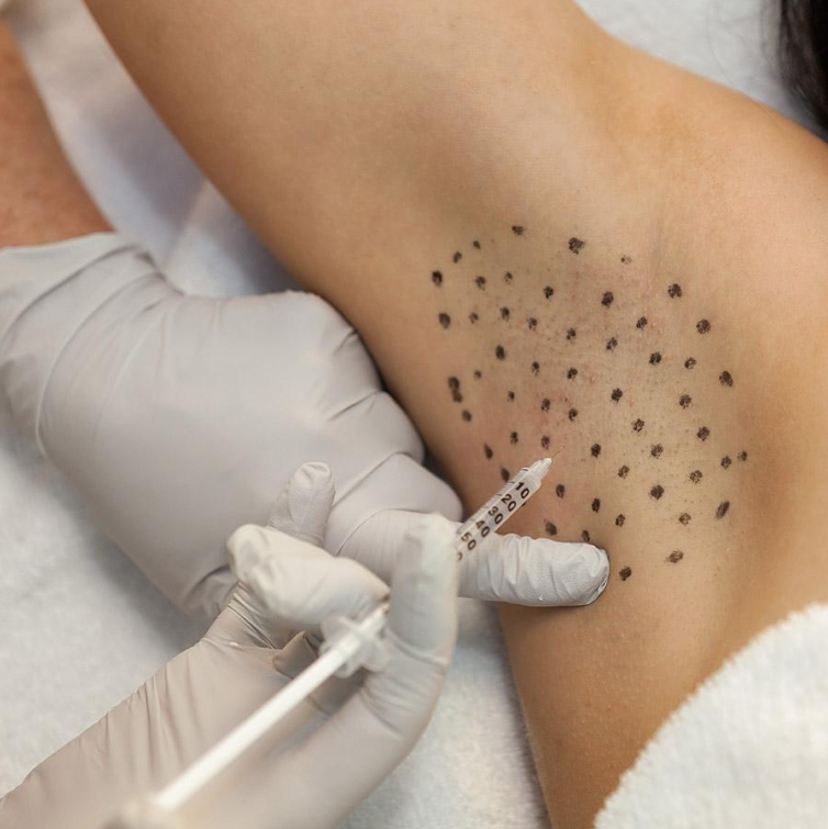Botox Υπεριδρωσίας — Advanced Derma